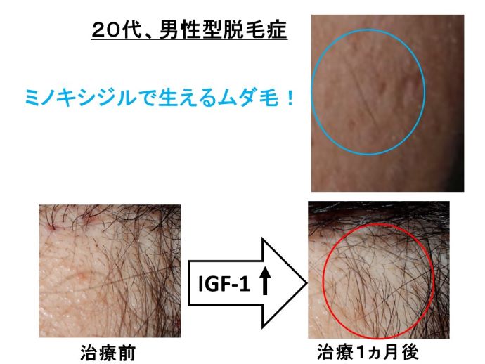 円形脱毛症　病院